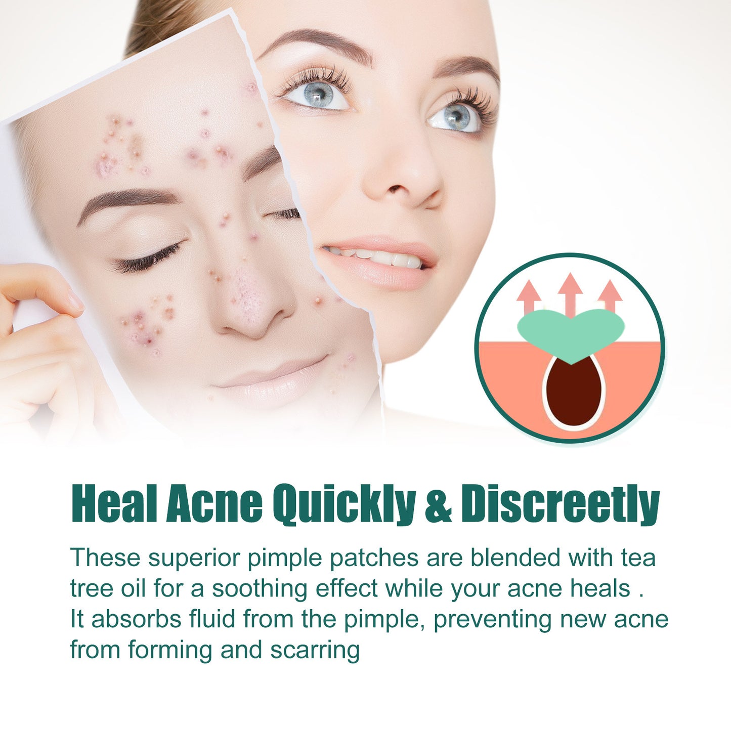Heart-Shaped Acne Patches with Tea Tree Oil & Hyaluronic Acid
