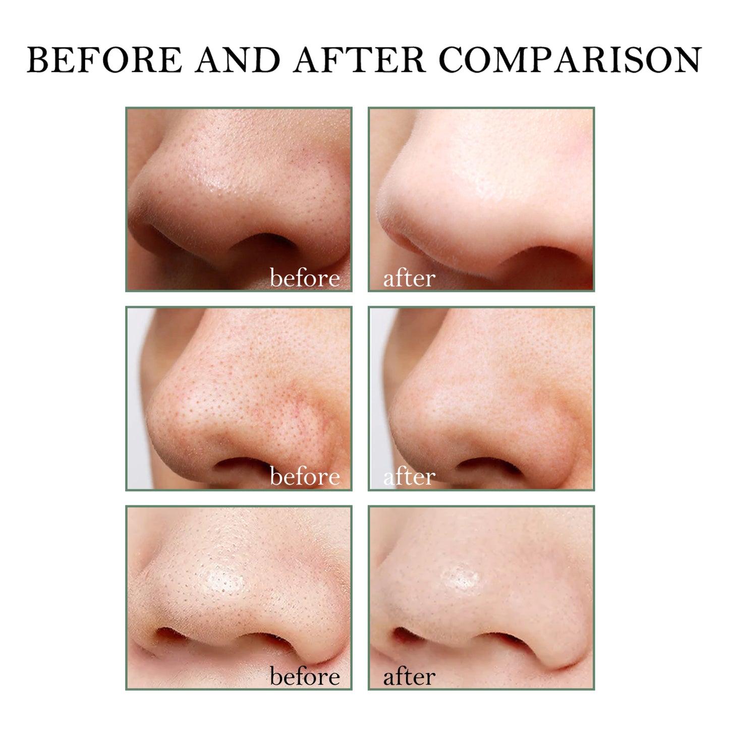 Blackhead Remover Cream Kit with 40 Pore Strips for Deep Pore Cleansing