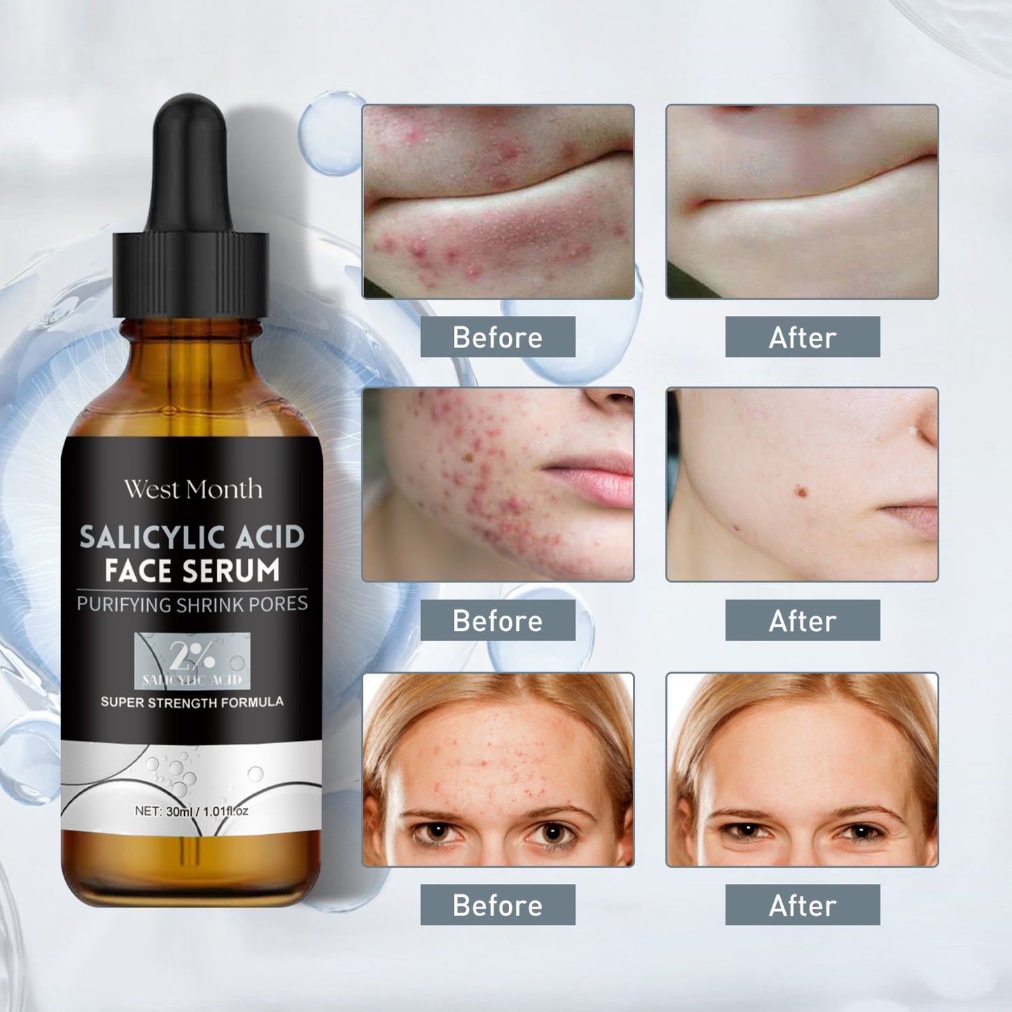 Salicylic Acid Facial Serum for Acne Repair and Oil Control - 30ml