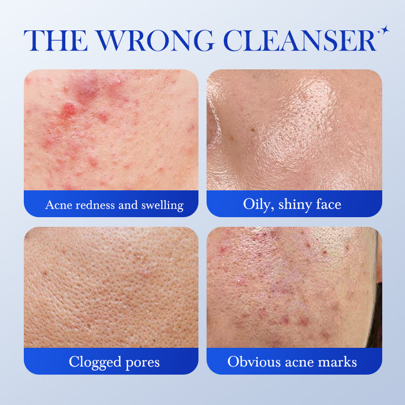 Salicylic Acid Acne Cleansing Milk 100g for Oily & Acne-Prone Skin