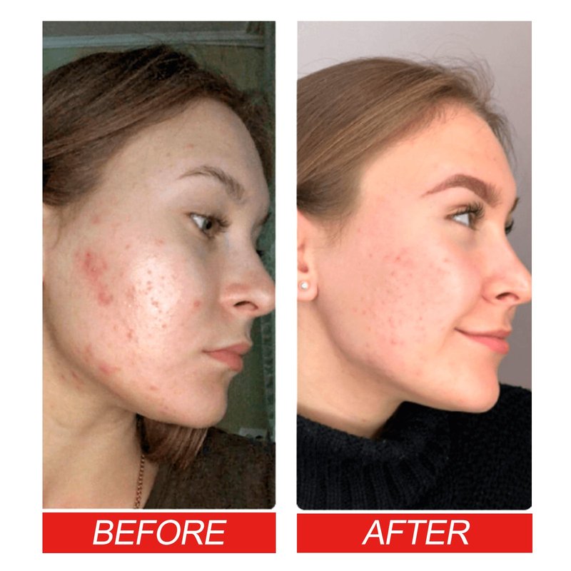 Facial Care Acne Patch Stickers - 200 Pieces, Hydrocool & Soothing