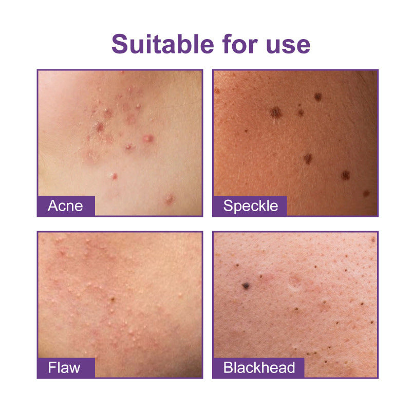 Waterproof Breathable Acne Patch Set - 180 Patches for Skin Repair