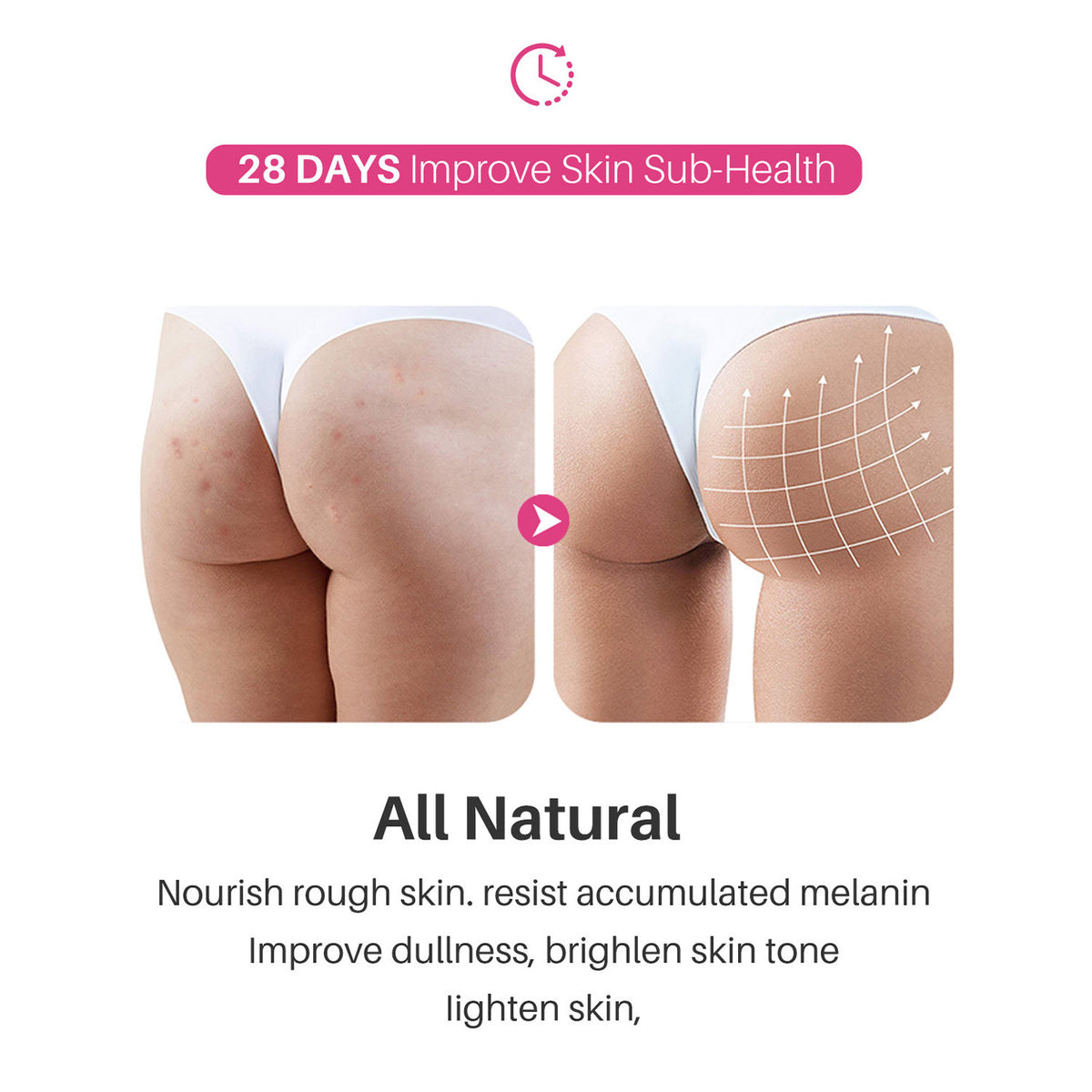 Hip and Leg Acne Moisturizing Cream - 50ml Body Care for Skin Relief