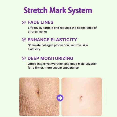 Stretch Mark System, Infused with Collagen and Elastin Support – Hydrating & Nourishing Formula for Smoother Looking Skin (1)