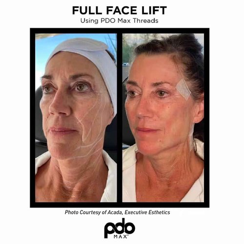 PHYMAT Pdo Threads for Face Lift Cog 18G100mm Pdo Molding Cog Bullet Blunt 20Pcs Threads for Face Lift