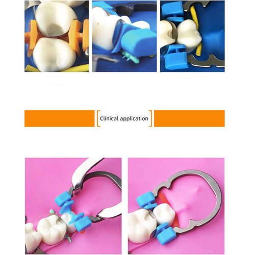 Dental Sectional Matrix Ring Clamp Spring Clip, Autoclavable Nickel Titanium Orthodontic Clamp Rings, Contoured Matrices System for Pre and Post Molars. (R2 Blue+Orange)