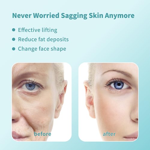 elves Pdo Threads for Face Lift/Whole body lifting Pdo Multi Threads L-Type Blunt 16pcs PDO Mono Threads 23G38mm Collagen Threads for Face Skin Tightening