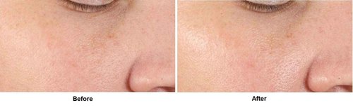 Dr. Dennis Gross Alpha Beta® Pore Perfecting & Refining Serum: for Enlarged, Clogged Pores with Excessive Oil, 1.0 fl oz