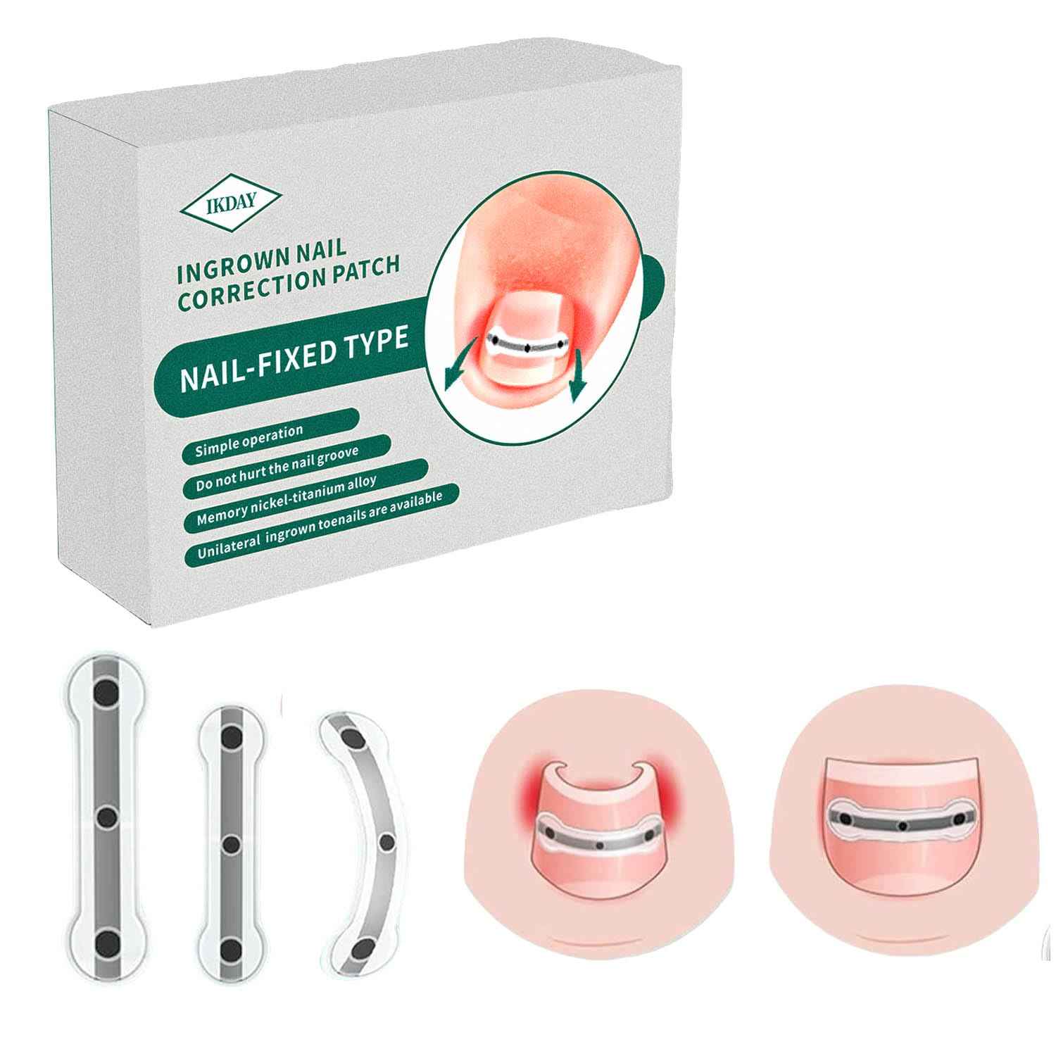Ingrown Toenail Treatment & Removal Kit - at Home Treatment for Ingrown Toenails, Titanium Alloy Ingrown Toenail Corrector, Nail Tools for Curved Nail Repair Suitable for Men Woman (((0.67/0.79in)))