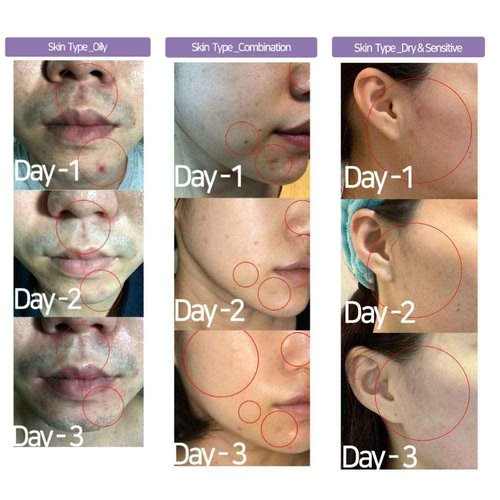 ACSEN AC Spot Solution, Concentrated Spot Serum, 72% Centella Asiatica Soothing Treatment for Acne, Blemishes, Irritation | Clinically Tested, Instant Calming and Cooling, Korean Skin Care