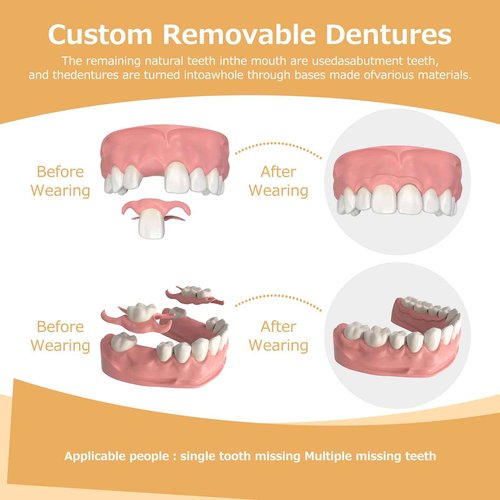 Partial Dentures - Dentures for Missing Teeth & Gaps - Lightweight & Unbreakable Replacement Teeth for Men & Women (1 Tooth)