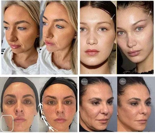 Oldream Pcl Cog Threads, Pcl Fishbone Threads 18G100mm, Pcl Threads for Face, Age-Defying Lift, Bullet Model, 20Pcs