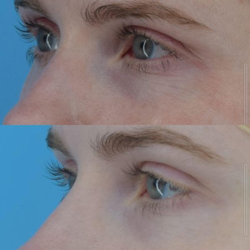 MesoLyft Fresh Eyes Anti-Aging Eye Cream For Dark Circles and Wrinkles