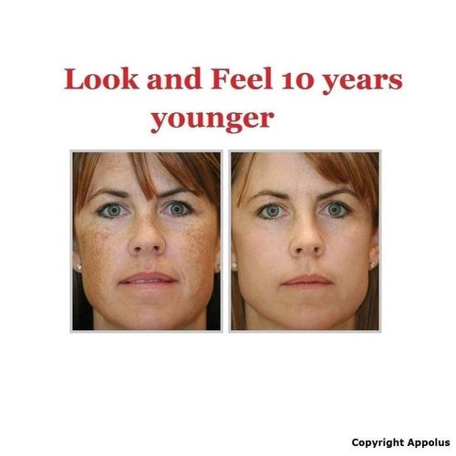 Microdermabrasion Machine - Appolus Premium Diamond Microdermabrasion Device Tool - 2 Diamond Tips - 5 Heads - Blackhead Blemishes Remover - Pores Fine Lines Minimizer