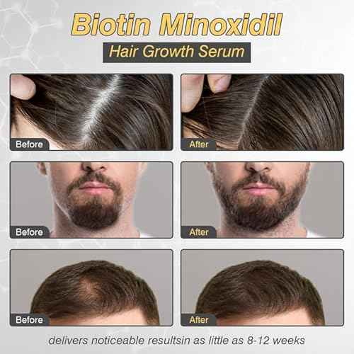 5% Minoxidil Hair Growth for Men and Women, Minoxidil Hair Growth Serum, Promotes Hair Growth, Strengthens Hair Follicles, Helps Prevent Hair Fall and Hair Loss