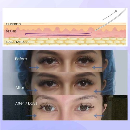 Minovd Pdo Threads for Eye Lift, Eye Lift Threads, Face Screw Threads, Blunt 30G25mm, 40Pcs, Smoothes Fine Lines Under the Eyes, Korea