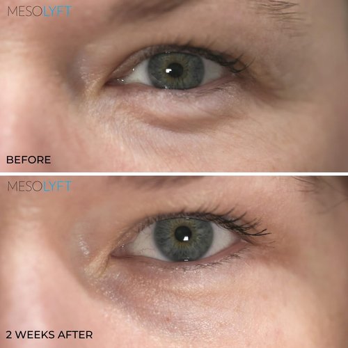 MesoLyft Fresh Eyes Anti-Aging Eye Cream For Dark Circles and Wrinkles