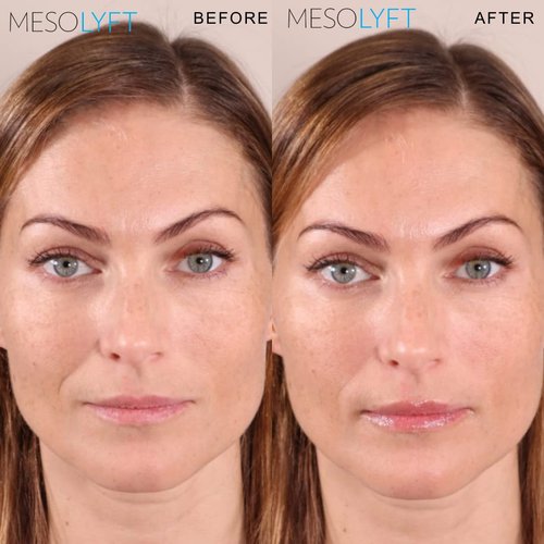 MESOLYFT Lip Plumper with Roller to Instantly Plump Lips, Promotes Hydration and Fullness, Plumping Lip Gloss for Fuller Lips, Serum to Moisturize Your Lips (12 ML)