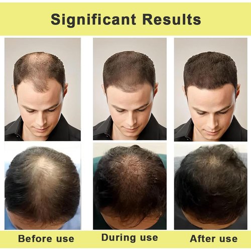 Thicair Hair Regrowth System - Advanced Hair Growth Treatment with Copper Peptides & Collagen, Knotweed and Ginseng Root Extract, Hydrating & Fuller Hair Kit for Fine or Thinning-Looking Hair (1 Pack)