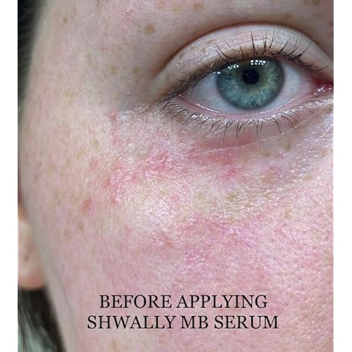 Shwally Methylene Blue Serums (Clear Spot Treatment, 1oz)