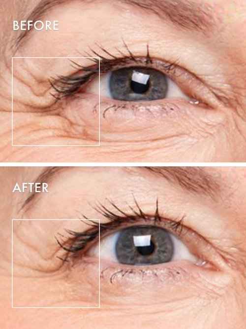 Depology MATRIXYL® 3000 Serum, Deepcare+ Serum-Infused Micro Dart Patche