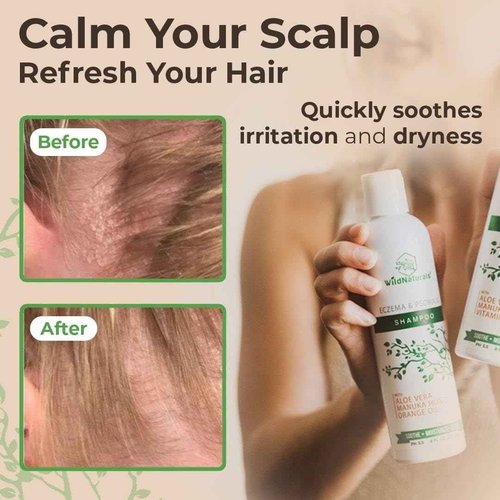Eczema & Psoriasis Treatment Shampoo - Anti-Dandruff, Scalp Relief for Dry & Itchy Skin - Hypoallergenic, Paraben & Fragrance-Free for Sensitive Scalp