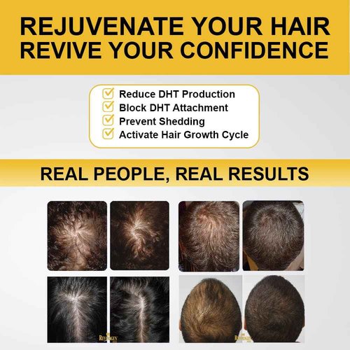 Revivogen MD Scalp Therapy Thinning Hair Solution, Shampoo & Conditioner Set