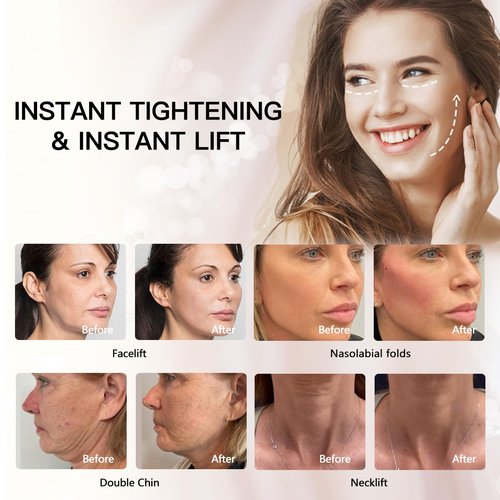 Auro Thread PDO Thread(Mono screw 29G 60MM) Lift/Face Body Lifting/Smooth Mono Screw Type 29G 60mm (50pieces)