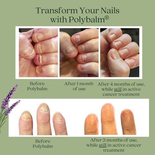 CHEMO NAIL PROTECTION | Clinically Proven & Doctor-Developed Oncology Supportive Care | 100% Natural | Strengthen & Repair Nails Damaged by Chemotherapy & Breast Cancer| Nail Toxicity Support| UK Made