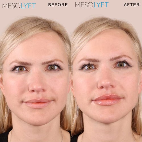 MESOLYFT Lip Plumper with Roller to Instantly Plump Lips, Promotes Hydration and Fullness, Plumping Lip Gloss for Fuller Lips, Serum to Moisturize Your Lips (12 ML)