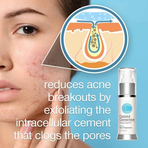 CONTROL CORRECTIVE Acne Spot Treatment Gel – 2% Salicylic Acid + Glycolic Acid Formula for Breakouts & Blemishes – With Witch Hazel, Aloe & Panthenol – 1 oz Clear Skin Serum