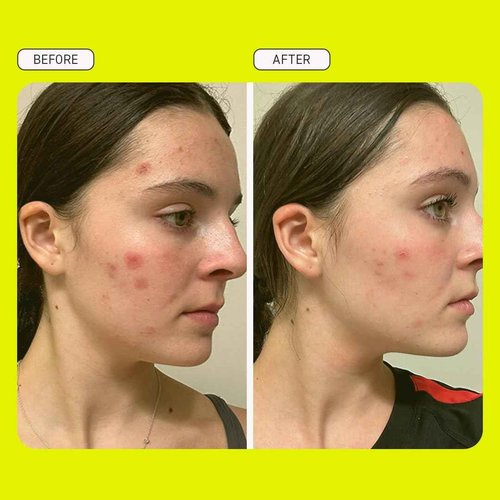 Evereden Preppy Skincare Collection with Triple Green Tea: Teen Skincare Steer Clear Balancing Jelly Cleanser Teen Face Wash, Let's Bounce Gel-Cream Moisturizer, & Balance Up Toner Pads for Face