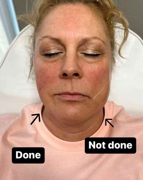 PHYMAT ACADA Pdo Threads for Face Lift Cog 18G100mm Pdo Fishbone Thread Bullet Blunt Cog Threads for Face Lift 20Pcs