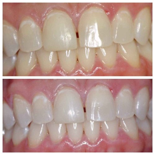 Ultra White 16% Teeth Whitening Gel Large 5 Tubes of Gel