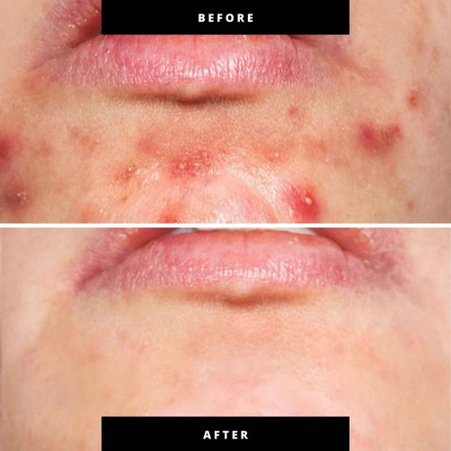 Kiierr Red & Blue Light Therapy for Face and Neck, Beauty Wand with Dual Light and Infared Modes