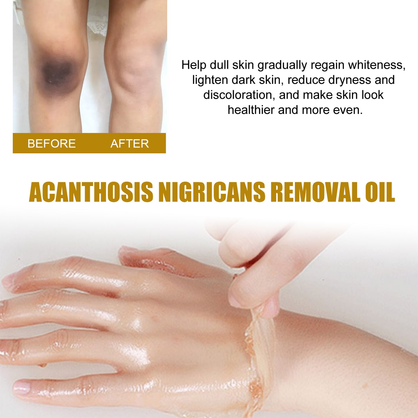 Acanthosis Nigricans Removal Oil - 50ml Brightening Exfoliating Skin Care