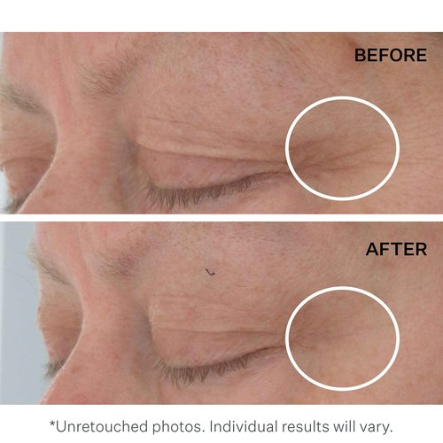 StriVectin Advanced Acids Hyaluronic Tripeptide Gel Cream for Eyes, Intense Hydration & Blue Light Neutralizer, 0.5 Fl Oz