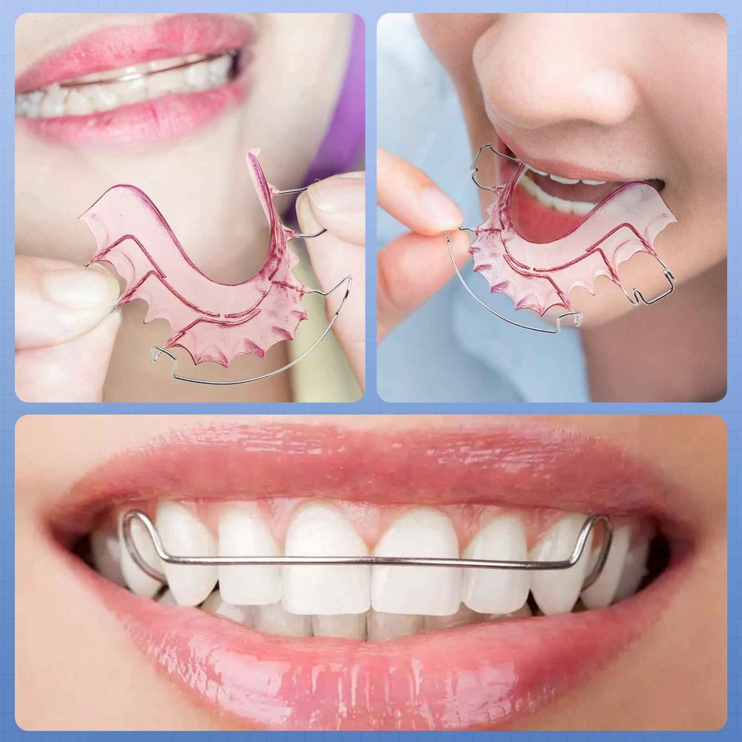 2 Hawley Retainers for Custom Teeth Retention – Comfortable & Durable Upper and Lower Retainers, Custom-Fit for Adults & Kids