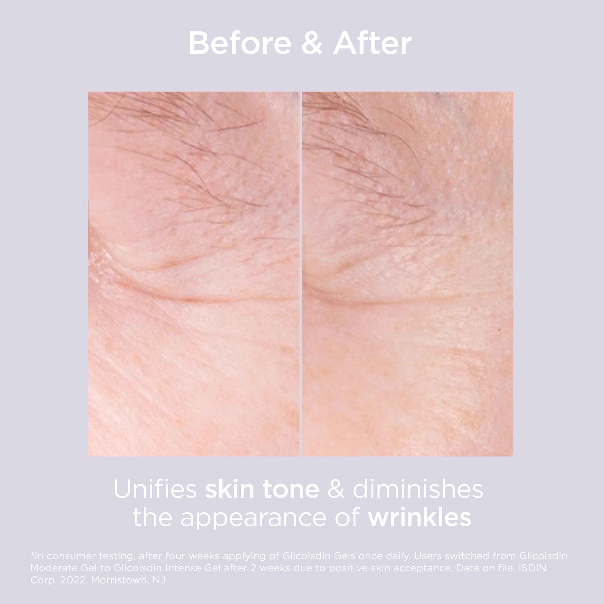 Glicoisdin 15 Moderate - Gel Exfoliant for Face with Glycolic Acid - 1.76 OZ