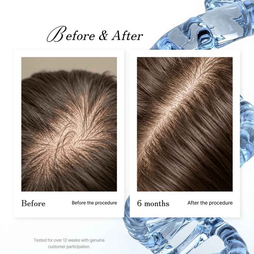 Simone Tec Hair Essentials Dx2-Dixidox Anti Hair Loss Treatment 118ML For Extreme Hair Loss Stop Hair Loss in 10 Days.