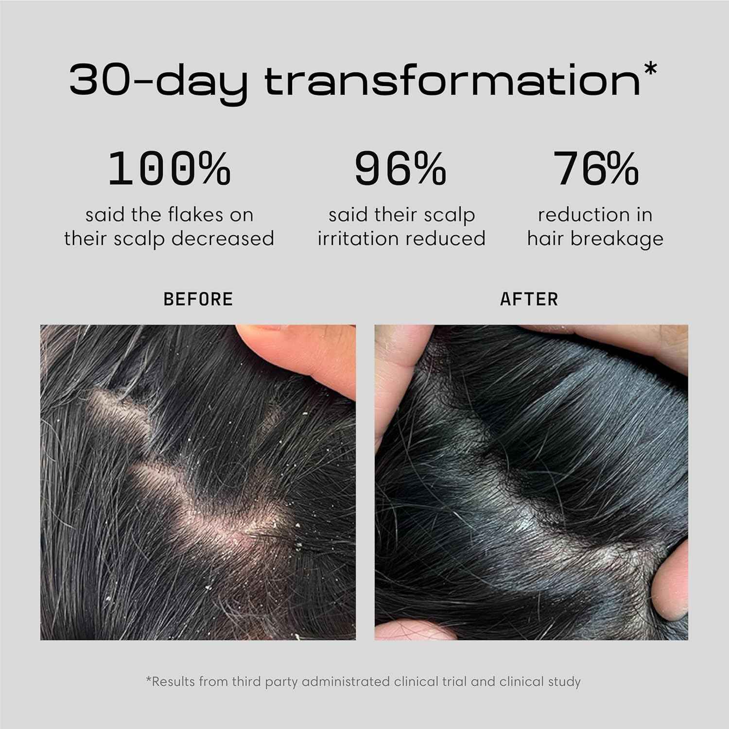 Jupiter Anti Dandruff Shampoo, Conditioner & Serum for Flaky, Itchy, Oily & Dry Scalp - Nourishes Scalp, Reduces Breakage & Flakes - Color-Safe, Sulfate-Free, Paraben-Free