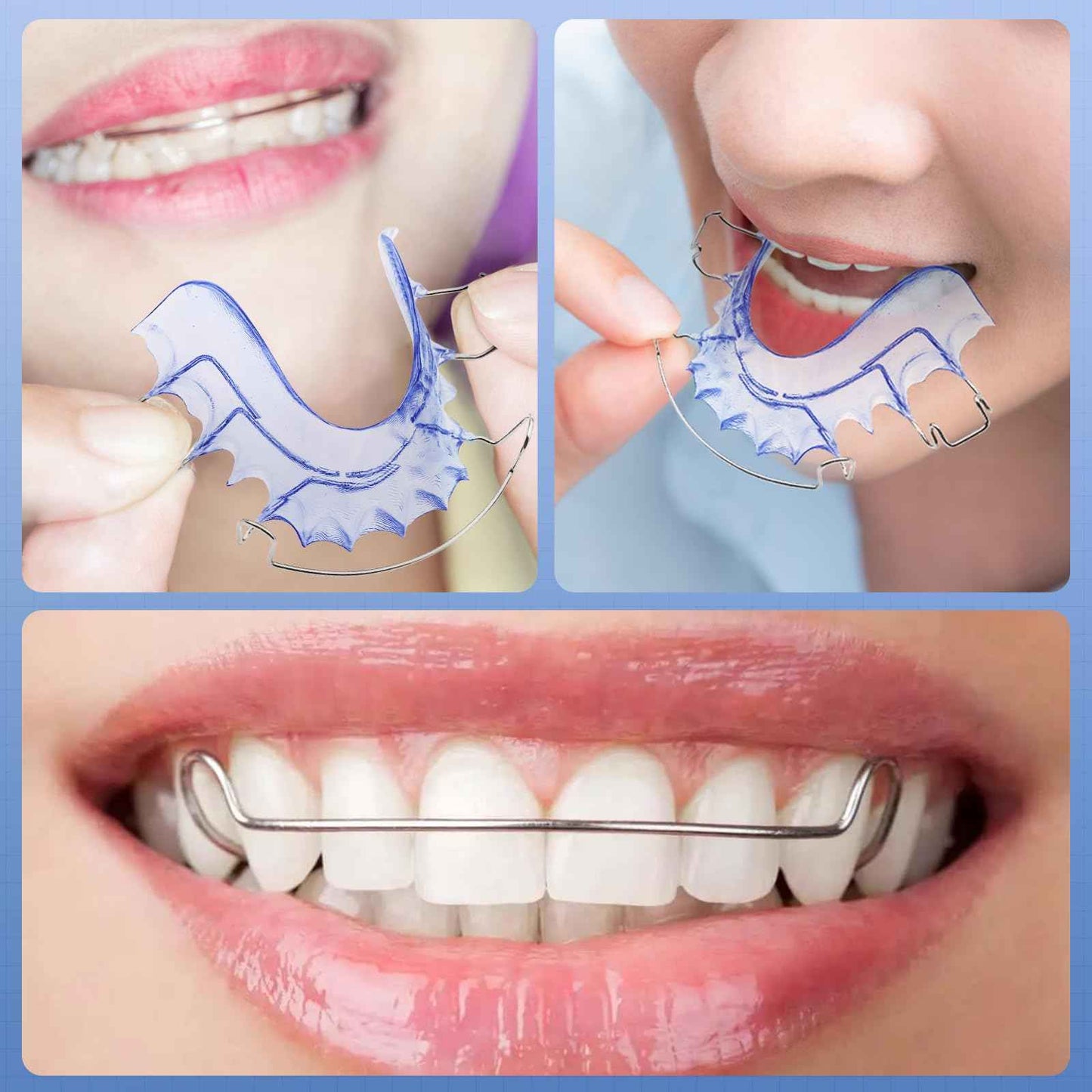 2 Hawley Retainers for Custom Teeth Retention – Comfortable & Durable Upper and Lower Retainers, Custom-Fit for Adults & Kids