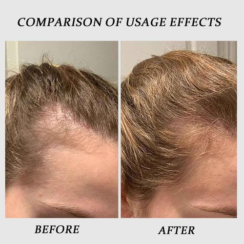 Thicair Hair Regrowth System - Volumizing Treatment with Copper Peptides & Collagen | Knotweed + Ginseng Root Extract | Supports Fuller, Healthier Looking Hair for Men & Women