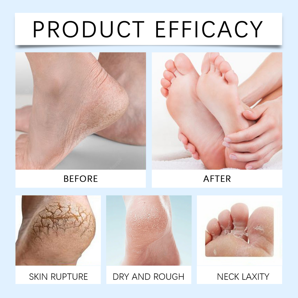 Urea Moisturizing Foot Repair Cream 100g