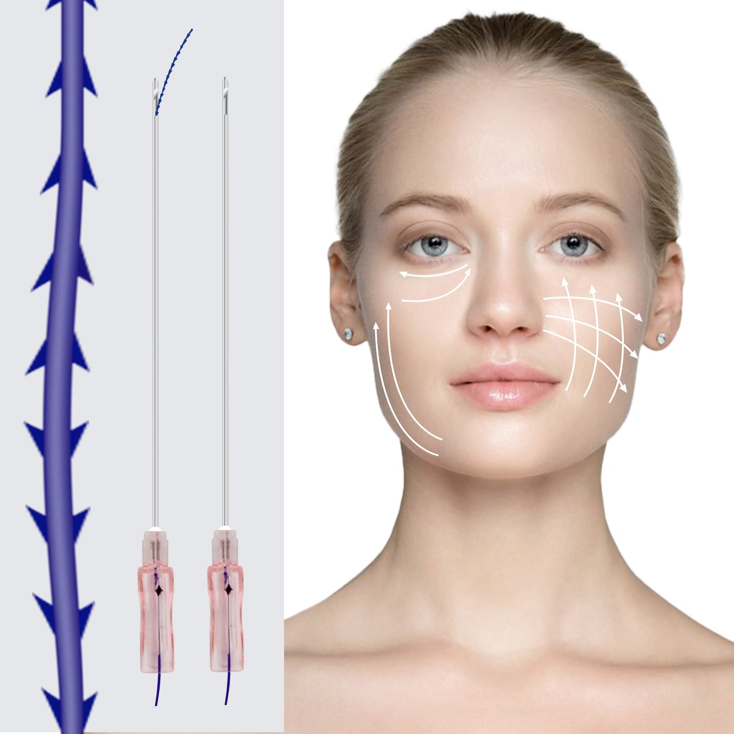 HYPOD Pdo Threads Lifting Fishbone, Pdo Thread Curved Barb 360 Degree Spiral Two Way Barb 16pcs, 18G100mm