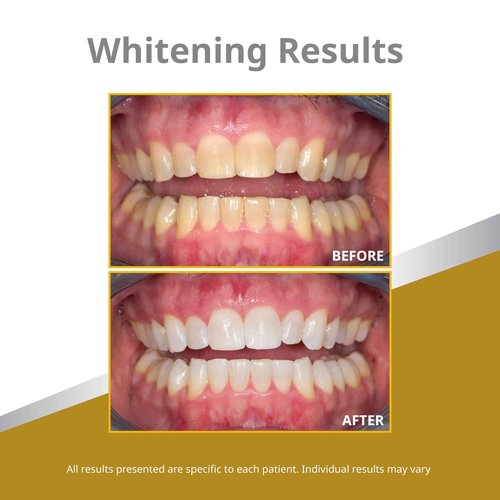 Opalescence 45% Syringes Teeth Whitening Gel - with PF - (12 Syringes) Refill Kit Carbamide Peroxide. Made by Ultradent, in Mint Flavor. Tooth Whitening 5359-6