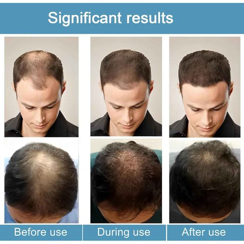 Thicair Hair Regrowth System - Advanced Hair Growth Treatment with Copper Peptides & Collagen, Knotweed and Ginseng Root Extract, Hydrating & Fuller Hair Kit for Fine or Thinning-Looking Hair (1)