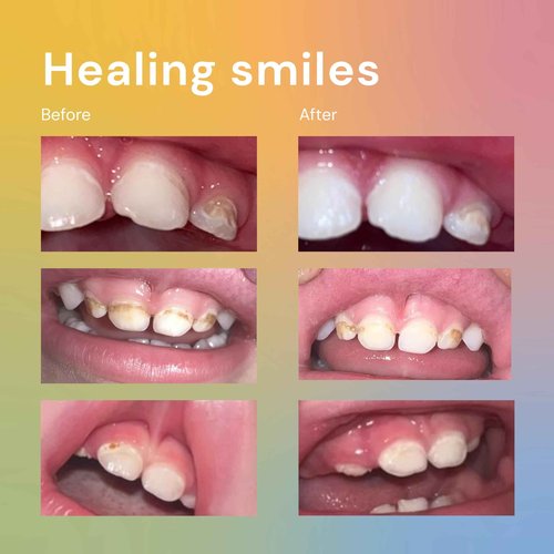 Bliss Energetics Remineralizing Tooth Puddy | Fluoride-Free with Hydroxyapatite | Remineralization | All Natural Ingredients & Preservative Free | Mineral-Rich Spot Treatment 2oz