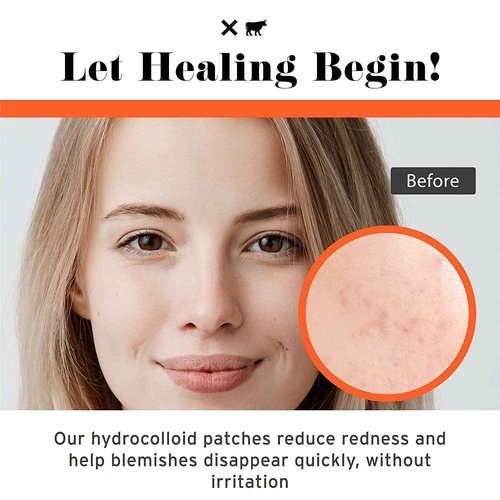 No Bad Stuff - All Day Healing Acne Patches, Hydrocolloid, Pimple Patches for All Skin Types, Invisible on All Skin Tones and Under Make Up, Waterproof Acne Spot Dots, 108 CT