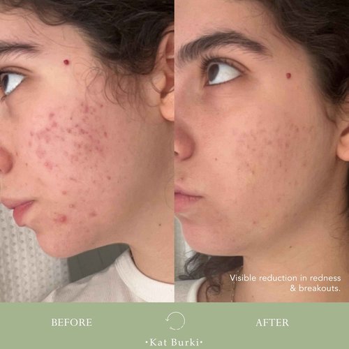 KAT BURKI VitaBiome Active Skin Optimizer With Vitamin C. Advanced Clearing and Redness Relief Face Mist for Breakout-Prone Skin, 3.4 Fl Oz